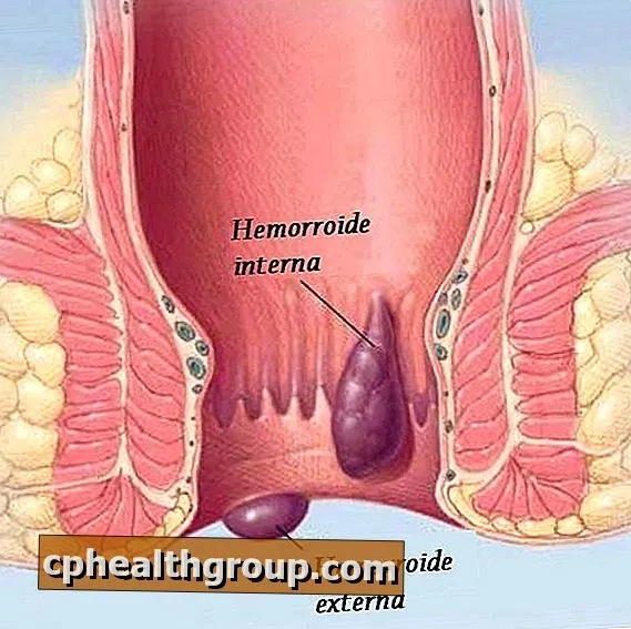 Hemoroxin : složení pouze přírodní složky.